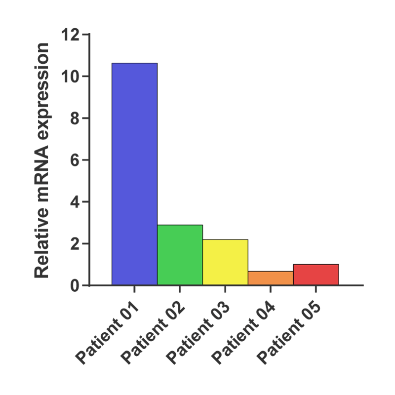 Differences in PD-L1 gene expression between primary samples, as shown by qPCR. PD-L1 expression in samples 04 and 05 is low compared to ‘reference’ sample 01 (> 10-fold difference). Expression values are calculated using ΔΔCq method, fold change is 2^(ΔCq PS 01 -ΔCq PS 0X)